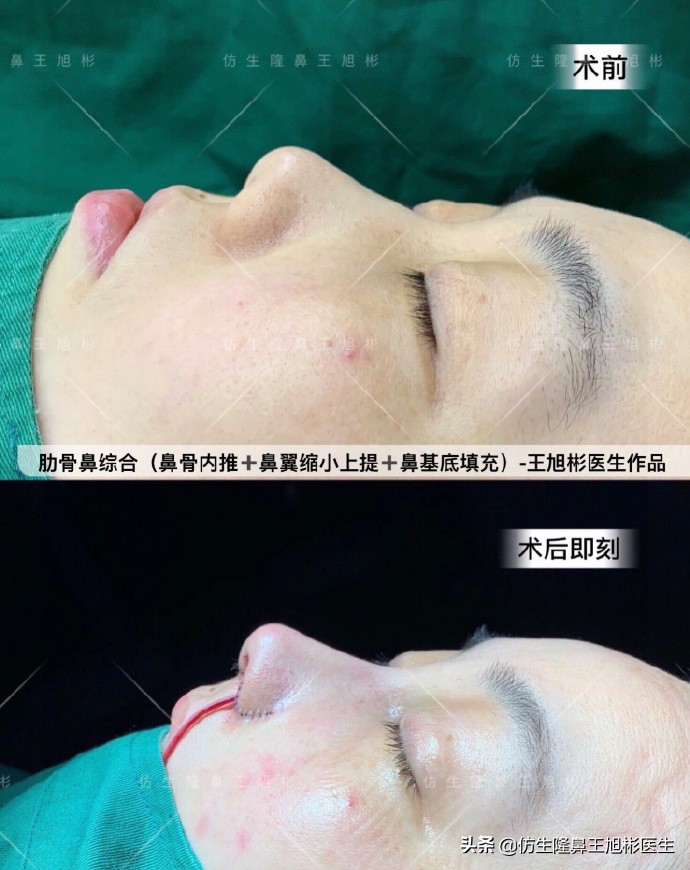 短鼻延长,短鼻塌鼻可以逆袭变长吗