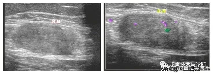 未婚女性卵巢查出包块,女左下腹有肿块是癌症吗