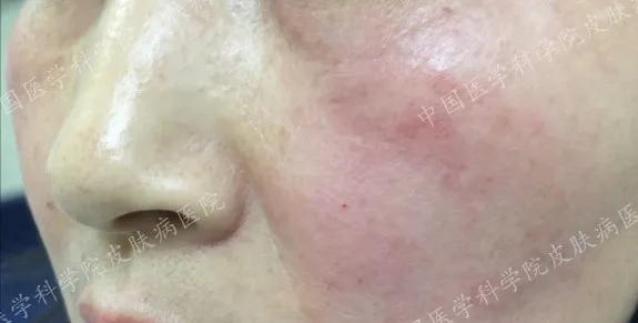 炎炎夏日如何正确护理皮肤,换季皮肤怎么防敏感