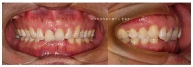 牙齿深覆合对脸型的影响,覆合型牙齿是怎么造成的