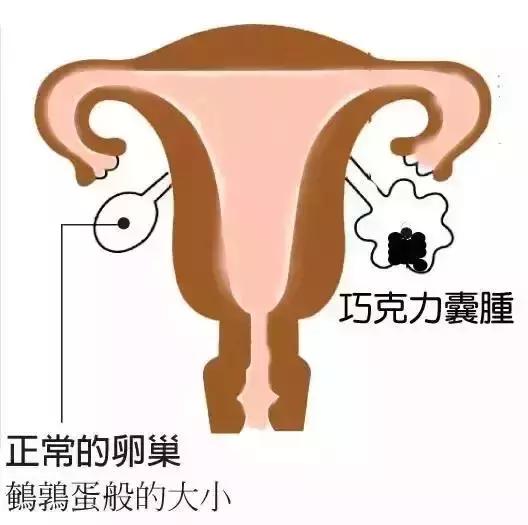 孕检很重要,怀孕会让卵巢囊肿跟着变大吗