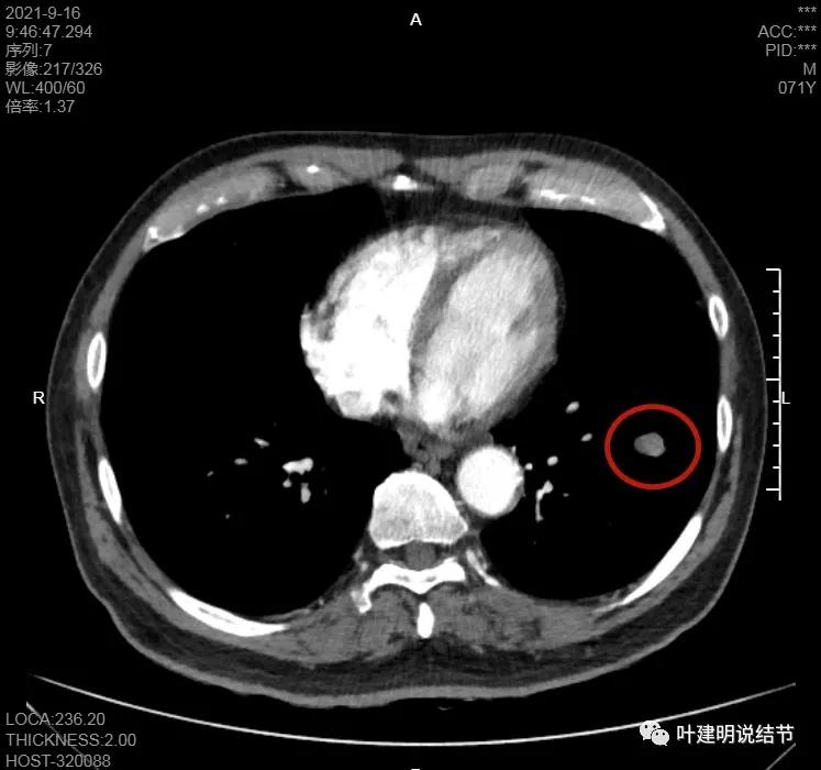 肺上有实性结节6mmx5mm是什么原因,肺上有1.7x1.8的实性结节该怎么办