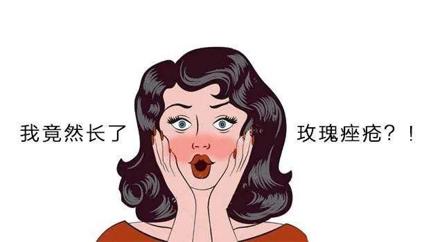 玫瑰疱疹是什么,玫瑰痤疮为什么脸会发烫
