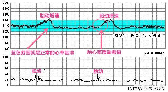 孕33周胎心监测应该在哪个位置,医生如何看胎心监护图