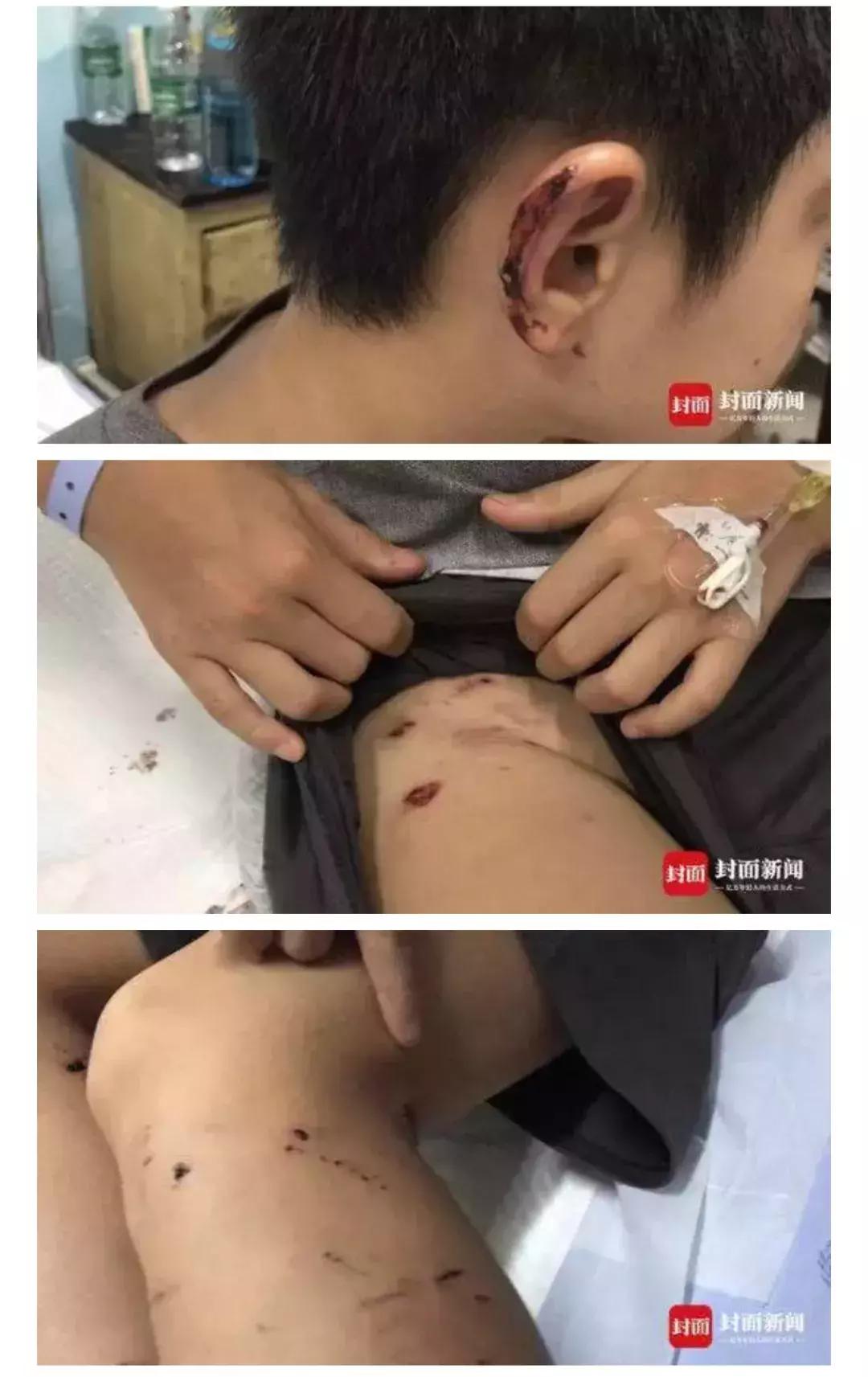 男子被一只狗疯咬,狗被狗咬出血会自愈吗