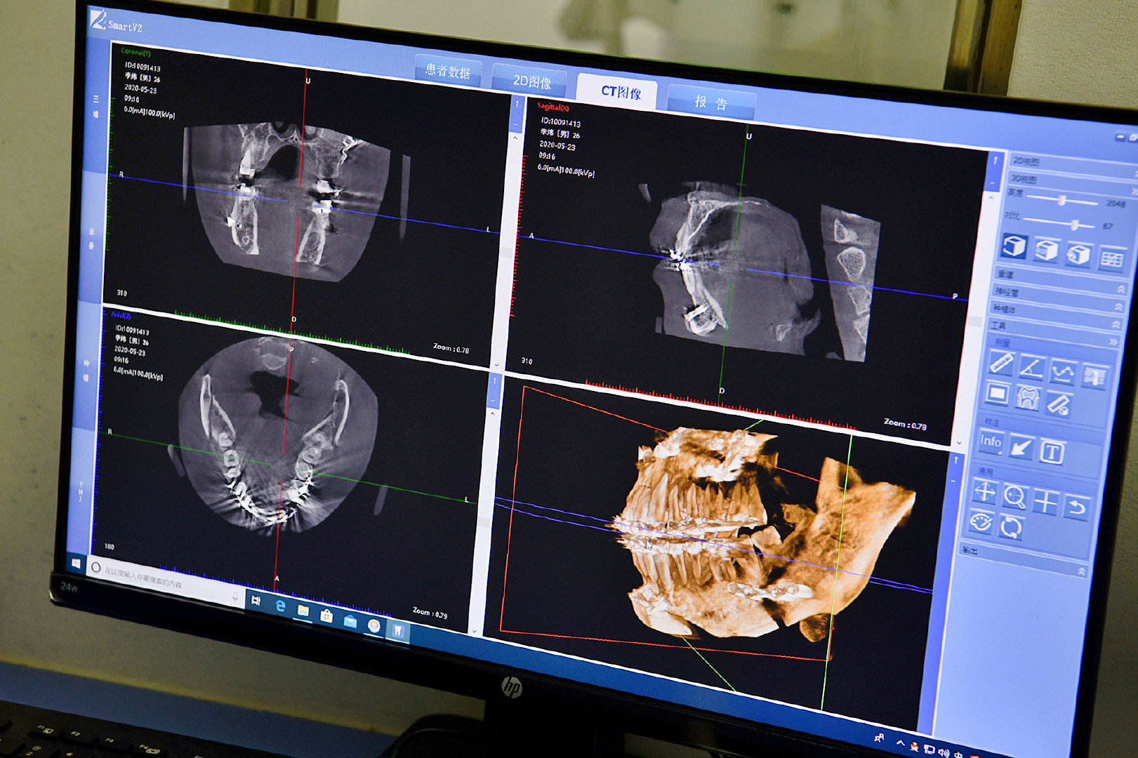 严重骨性地包天正畸效果,地包天矫正后又反颌怎么办