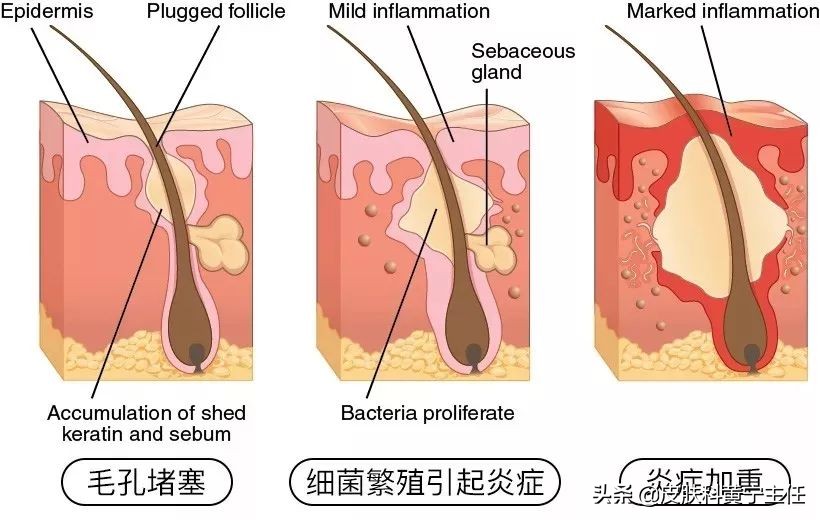 宅家的1个多月都没化妆，竟然还爆痘
