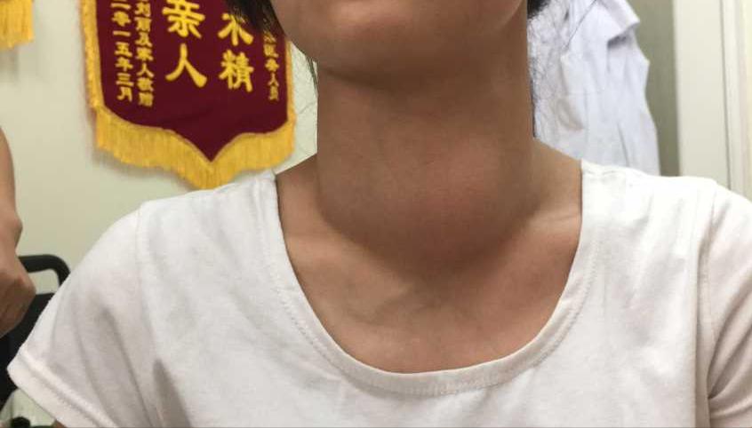 甲状腺结节07x06实性结节严重吗,甲状腺结节1.2厘米囊实性结节