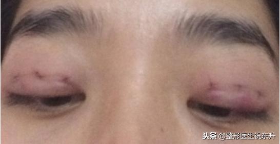 单眼皮与双眼皮的优缺点,欧式双眼皮有什么优缺点