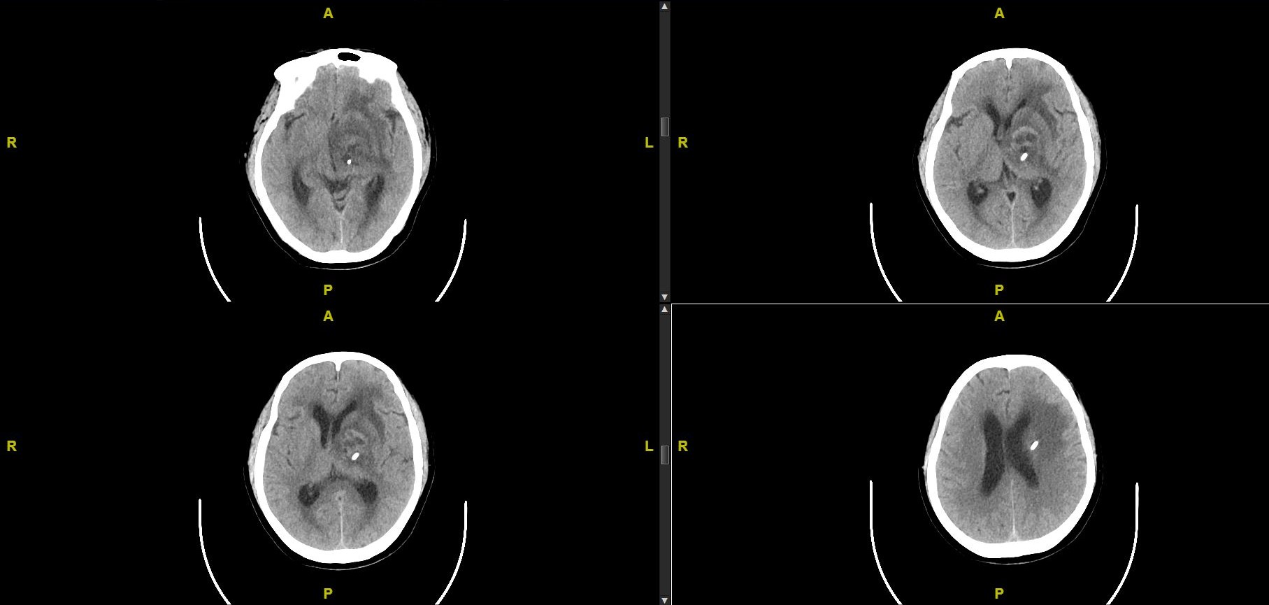 欧马亚囊（Ommaya囊）植入治疗巨大囊性脑转移瘤一例