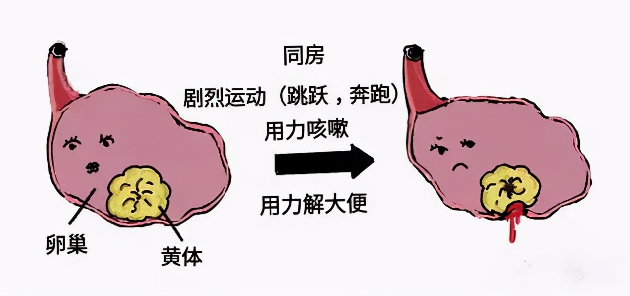同房后开始肚子痛，绝对不能忽视