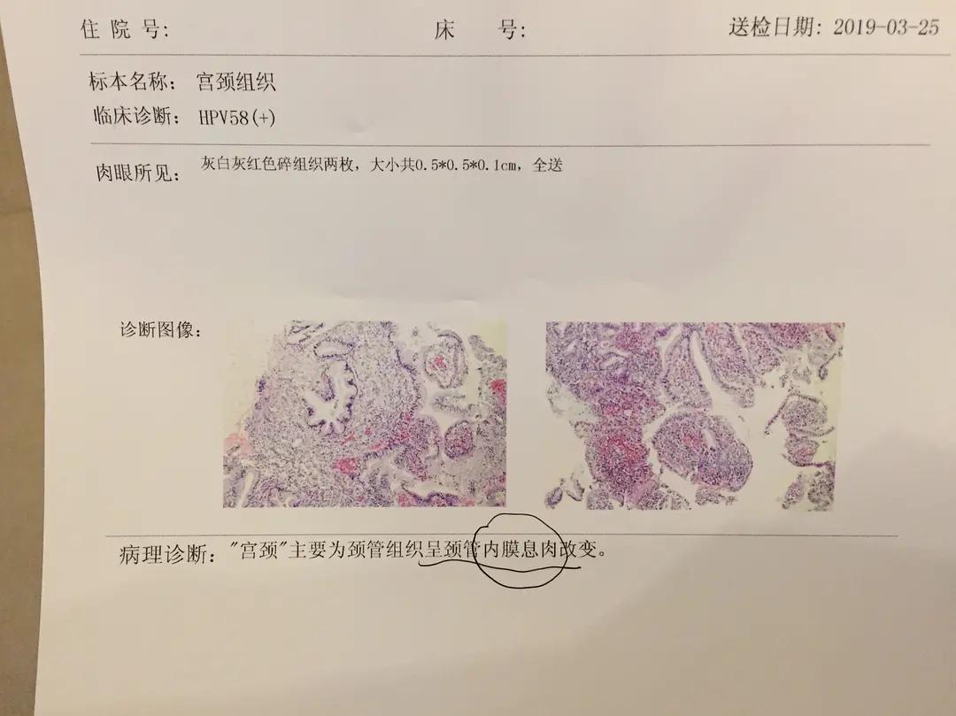 hpv58治疗期间关注事项,hpv58一级病变转阴历程