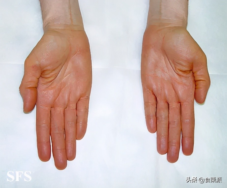 胡萝卜吃多了会变黄还是变白,胡萝卜素吃多变成小黄人