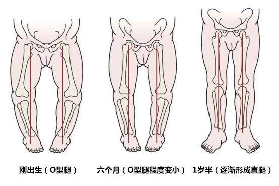 孩子x型腿应该怎么治疗,两岁孩子x型腿需要矫正吗