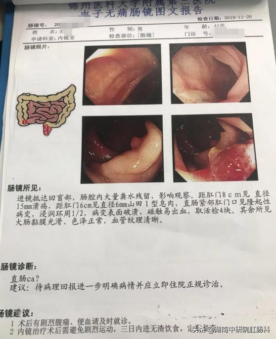 低位直肠癌早期能保肛吗,低位直肠癌晚期治愈吗