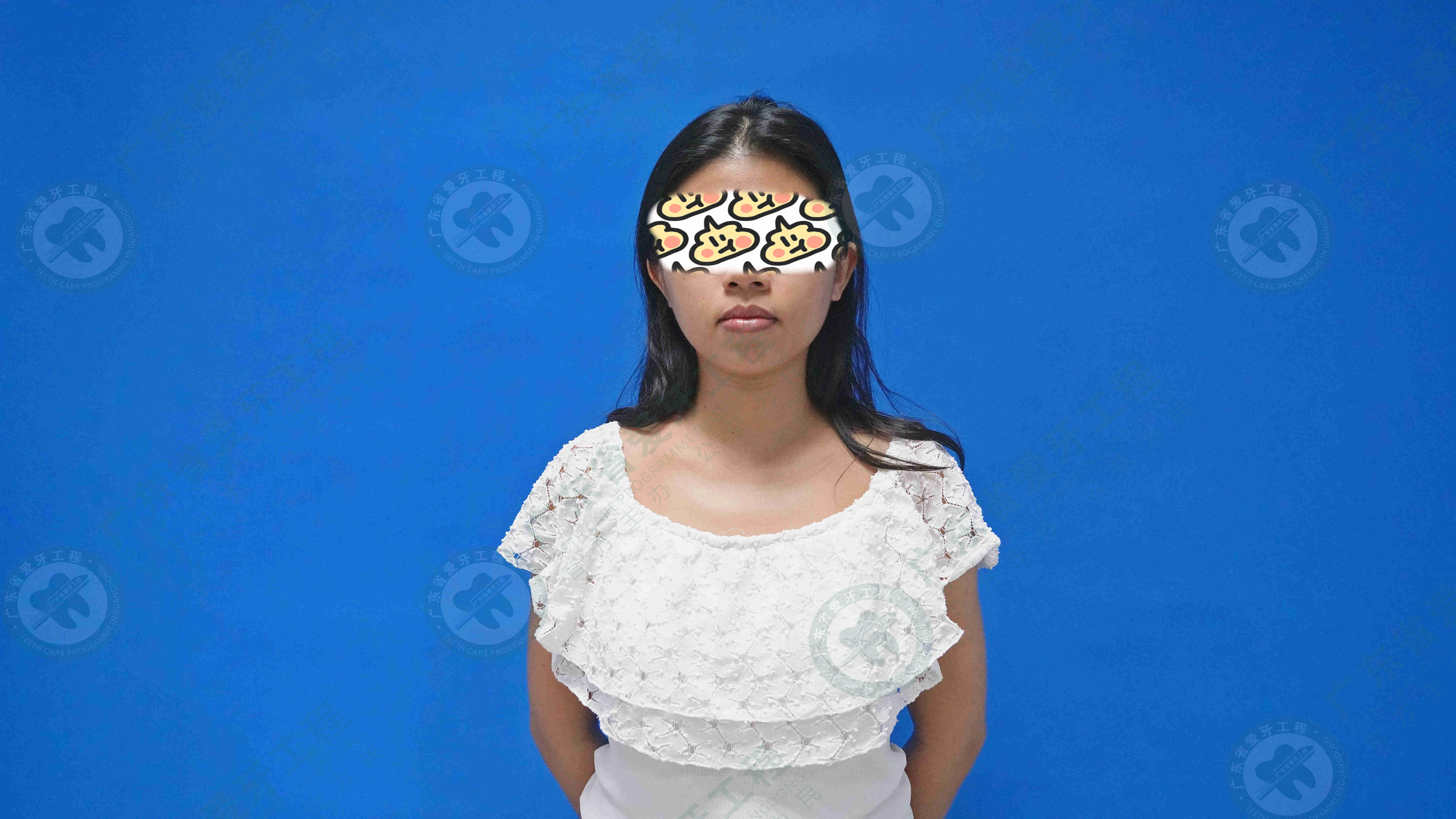 骨性龅牙凸嘴正颌手术全过程,29岁女生稍微骨性龅牙怎么矫正