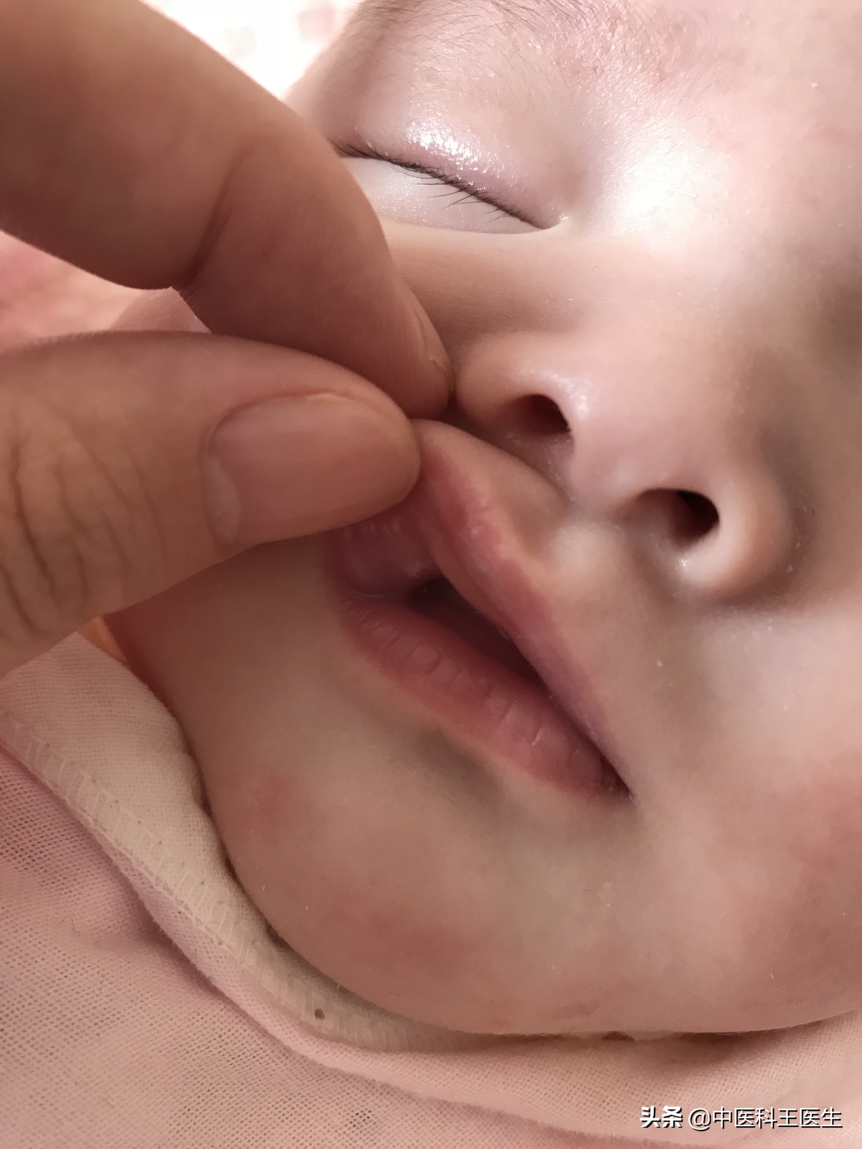 宝宝鹅口疮严重最佳治疗方法,婴儿鹅口疮反反复复怎么才能彻底