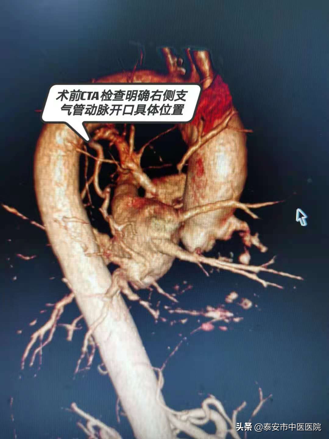 咳血要做微创手术吗,咳血需要做介入疗法吗
