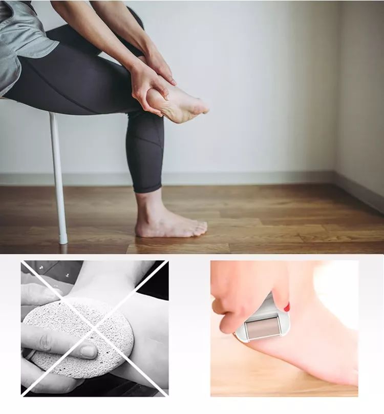 脚上老茧太厚了走路不舒服,脚上老茧不硬了发黄