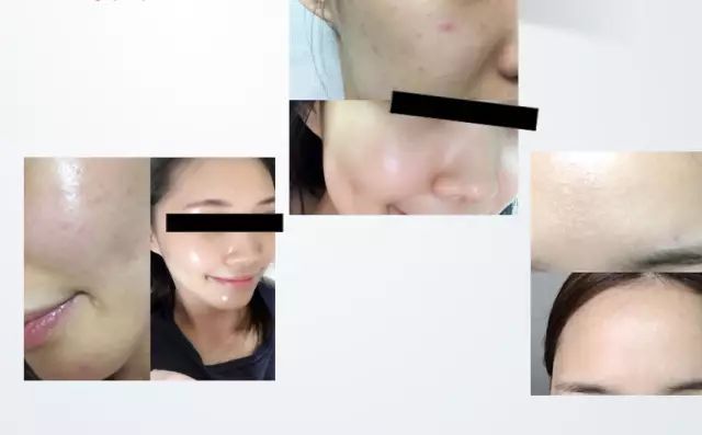 毛孔粗大皮肤暗黄干燥怎么办,毛孔粗大皮肤暗黄怎么治疗