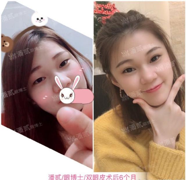 什么样的肿眼泡适合全切,什么样的肿眼泡不用动提肌