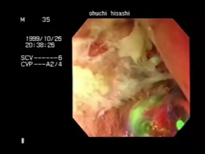 83天痛不欲生的活体腐烂，他在一次核事故后缓慢死去