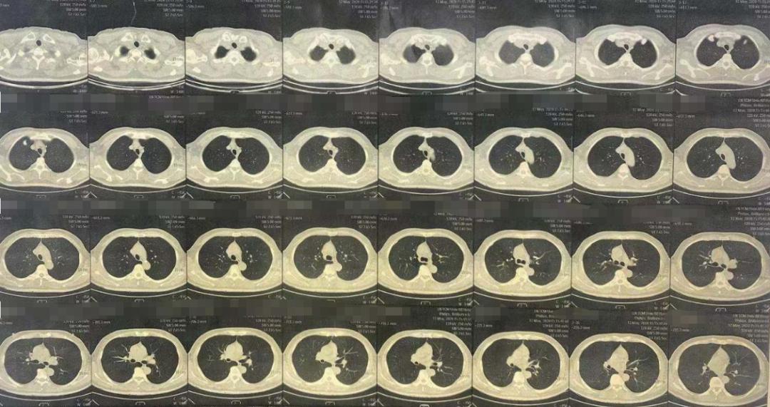 肺部肿块抗炎治疗无变化怎么办,病灶呈轻中度持续强化