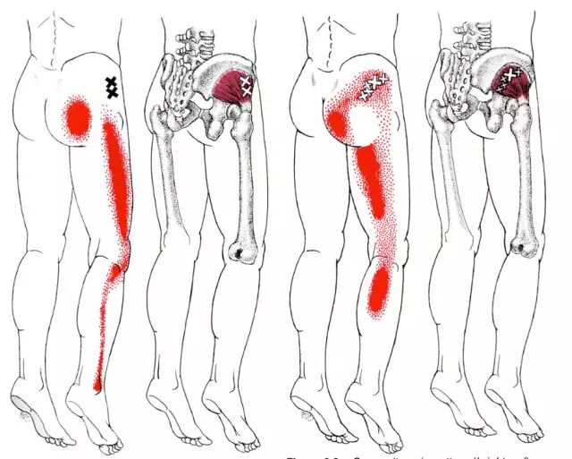 臀部大腿小腿不适,右侧大腿和臀部不适