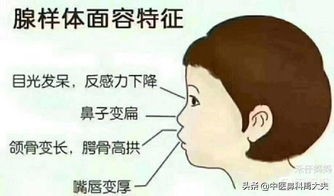 什么是腺样体肥大面容图片,腺样体肥大是什么样子的