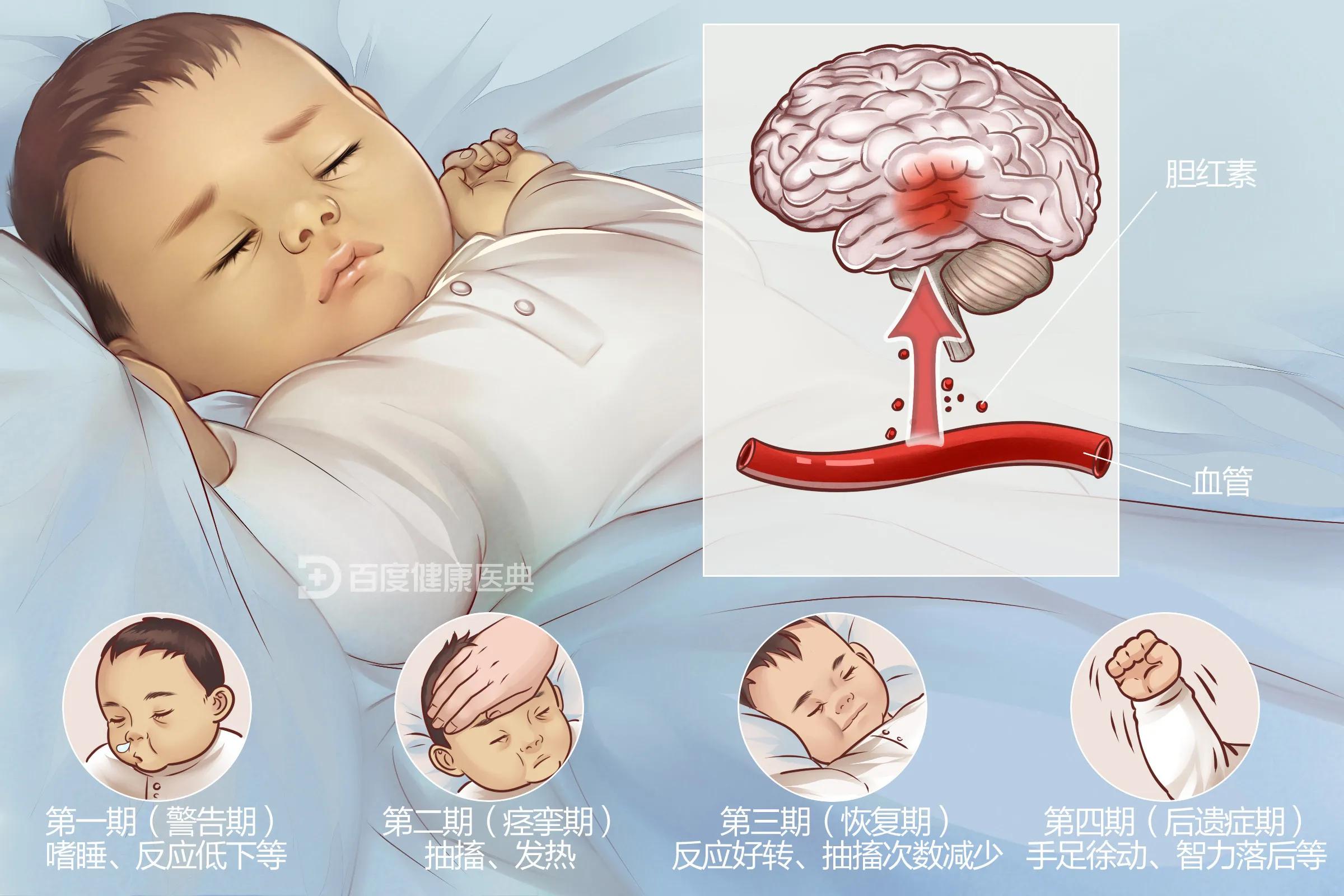 十个月的宝宝黄疸9.7,新生儿长黄疸的最佳治疗方法