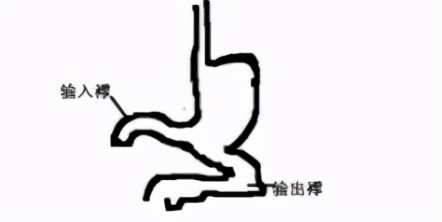 胃镜完整切除肿瘤是根治性治疗吗,胃有肿瘤做胃镜能查出来吗