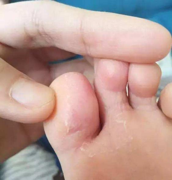 脚气脚后跟干裂起硬皮开裂怎么办,脚气脚臭脚痒脚开裂的克星
