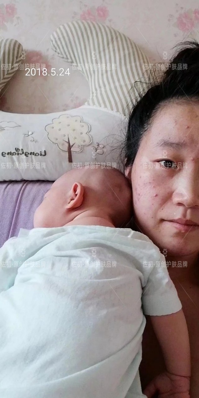 生完孩子烂脸,生完孩子脸上垮了怎样处理