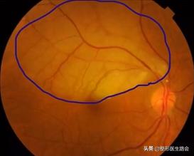 玻尿酸导致血管栓塞图,警惕注射过程中的风险