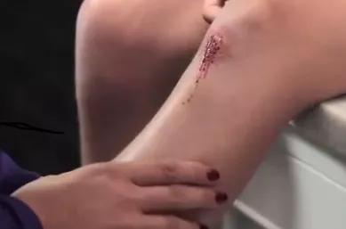 疤痕怎么自愈,疤痕是怎样治疗的呢