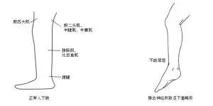 脑梗患者足下垂如何康复,脑梗康复腿站不直最好的方法
