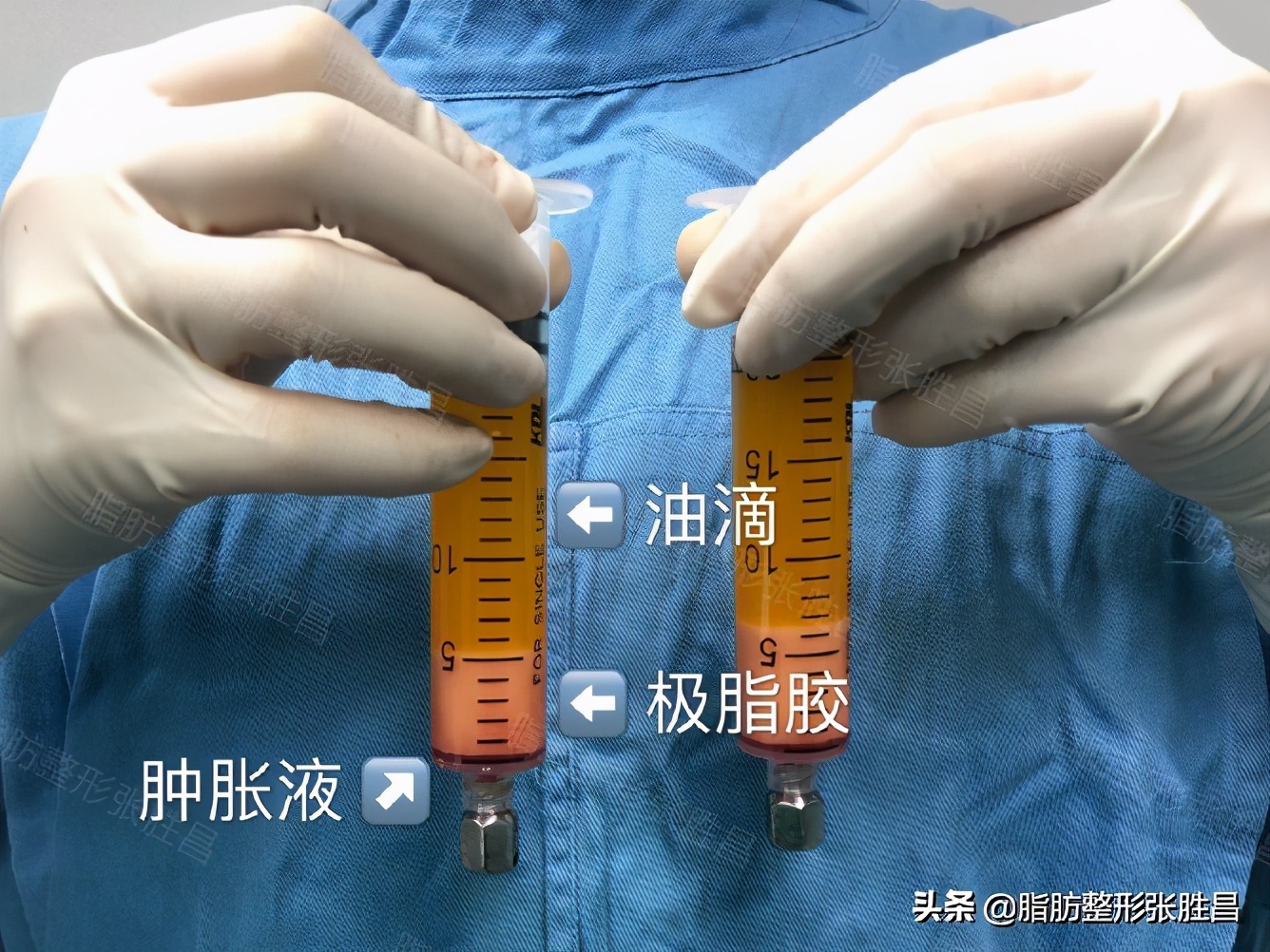 自体脂肪填充变丑了怎么办,自体脂肪填充面部会造成面部变形