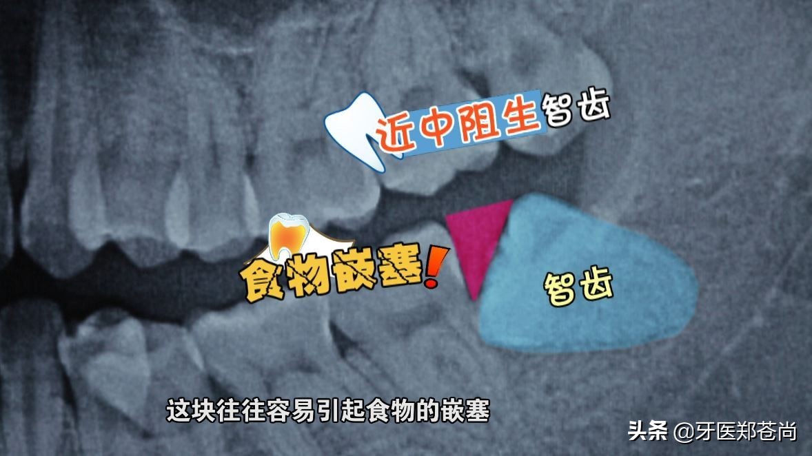 没长出来的智齿拔了不痛正常吗,为什么智齿没长出来却总是疼呢