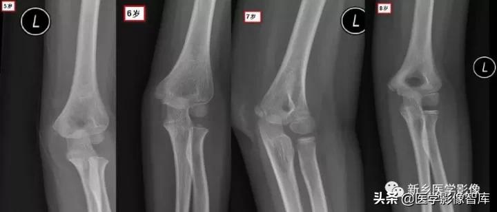 肘关节x线测量,肘关节骨骺示意图