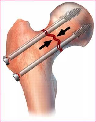 80多岁老人摔倒后续,86岁的老人把大胯摔骨折怎么办