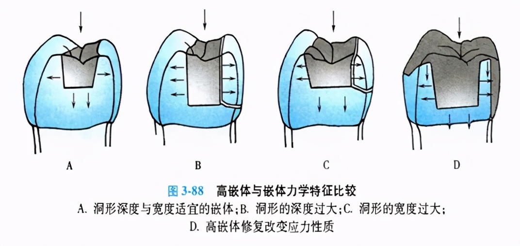 牙科嵌体的处理,牙科医生讲义