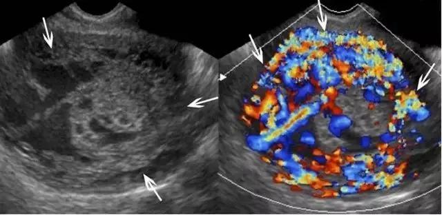 临床上最常见的异常胎盘,前置胎盘和低置胎盘超声