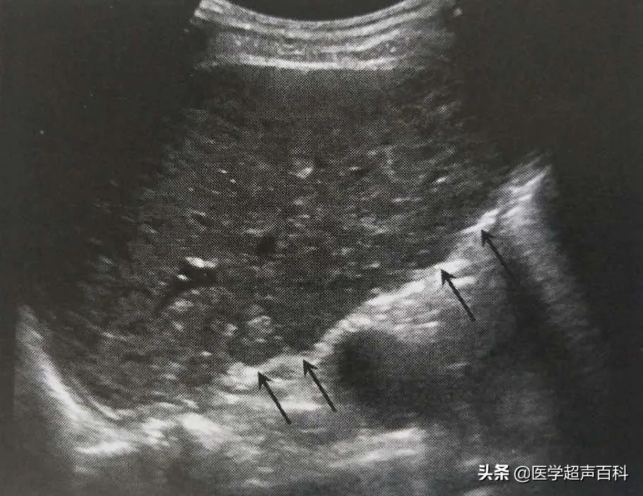 肝硬化上消化道出血了还能好转吗,肝硬化上消化道出血引起昏迷