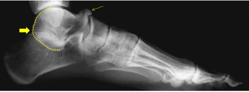 小孩玩多了脚酸脚痛怎么回事,小孩子玩着玩着就脚痛