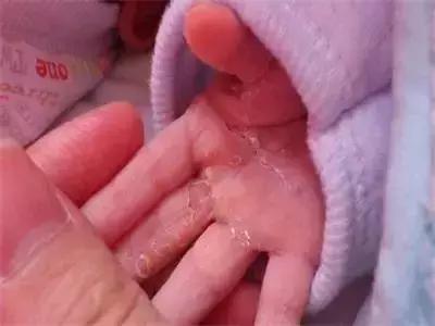 新生儿皮肤问题怎么解决,家有新生儿怎么办