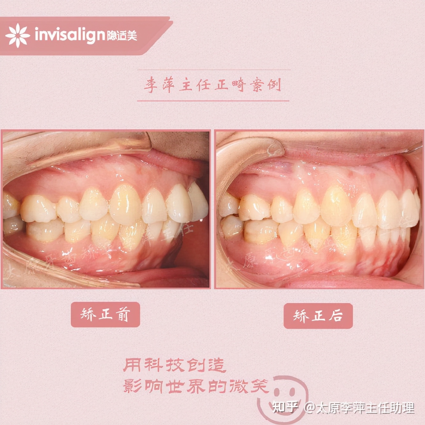 太原牙齿矫正靠谱吗,太原成人隐形牙套牙齿不齐