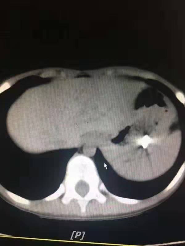 4岁男孩吞2cm钉子,4岁男孩吞下一颗5厘米钢钉