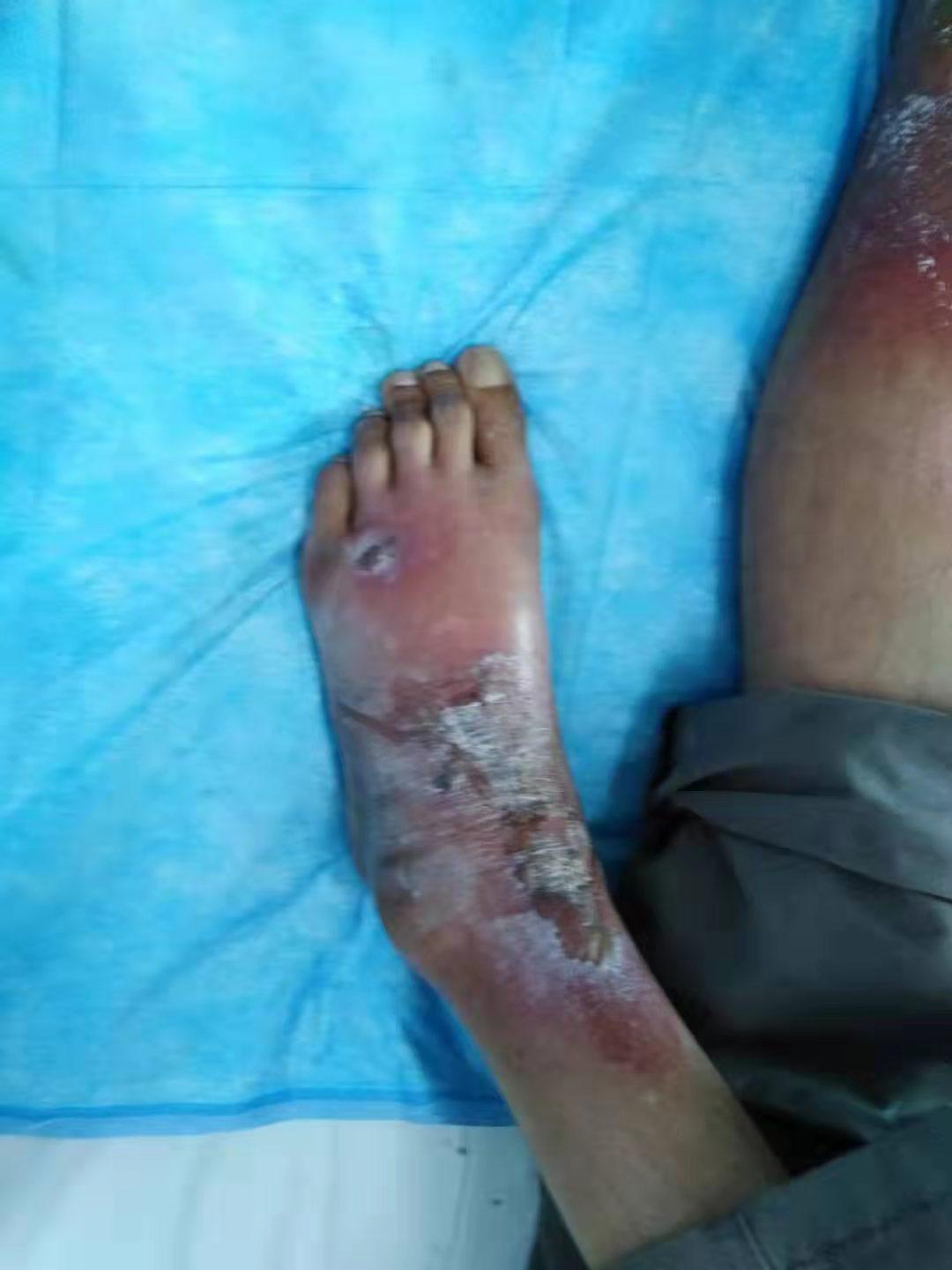 下肢麻木、溃烂要谨慎，烟酸缺乏是病因