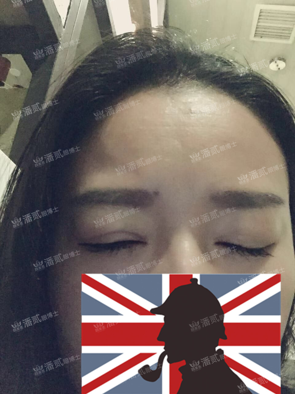 提肌矫正失败的表现眼皮睁不开,做完提肌眼睛前半段下垂