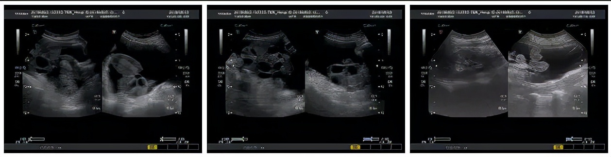 卵巢过度刺激恶心呕吐,卵巢过度刺激能移植吗